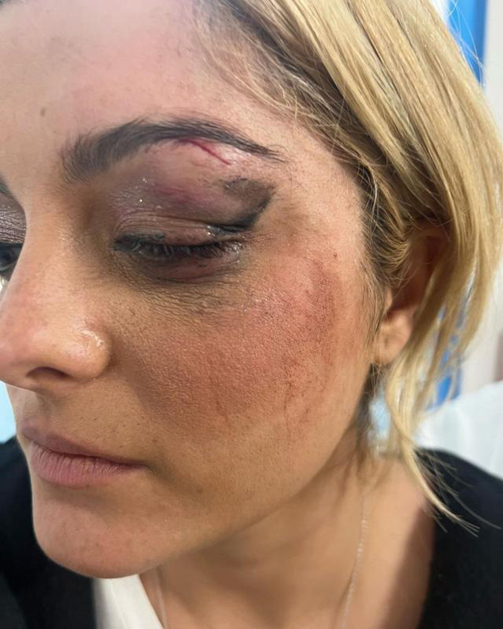 Ca sĩ Bebe Rexha bị thương khi bị fan ném điện thoại trúng mặt