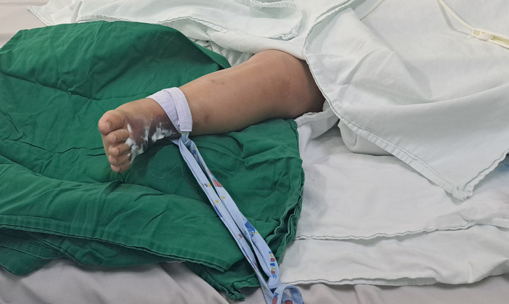 Vết thương ở chân của bé trai 22 tháng tuổi bị rắn hổ mèo cắn - Ảnh: Bệnh viện cung cấp 
