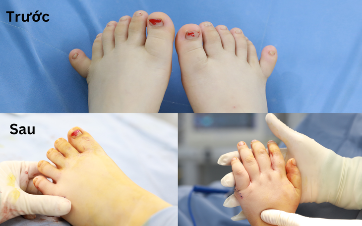 Bàn chân 6 ngón trước khi phẫu thuật và bàn tay, bàn chân sau khi phẫu thuật - Ảnh: N.TRINH