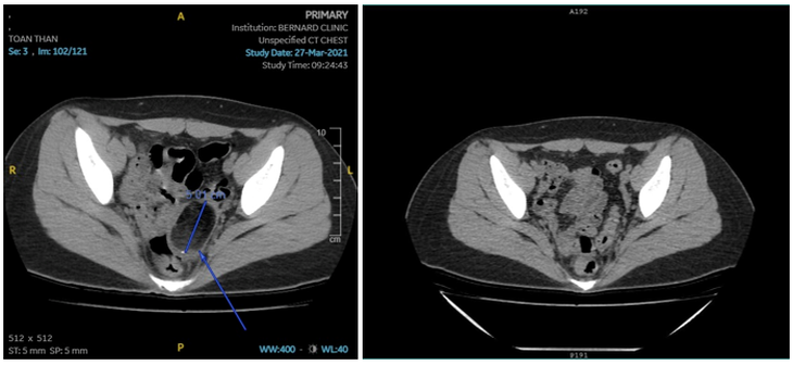 (Trái): U buồng trứng được phát hiện trên CT; (Phải): Hình ảnh chụp CT tái khám sau phẫu thuật: Kết quả bình thường - Ảnh: Bernard Healthcare cung cấp