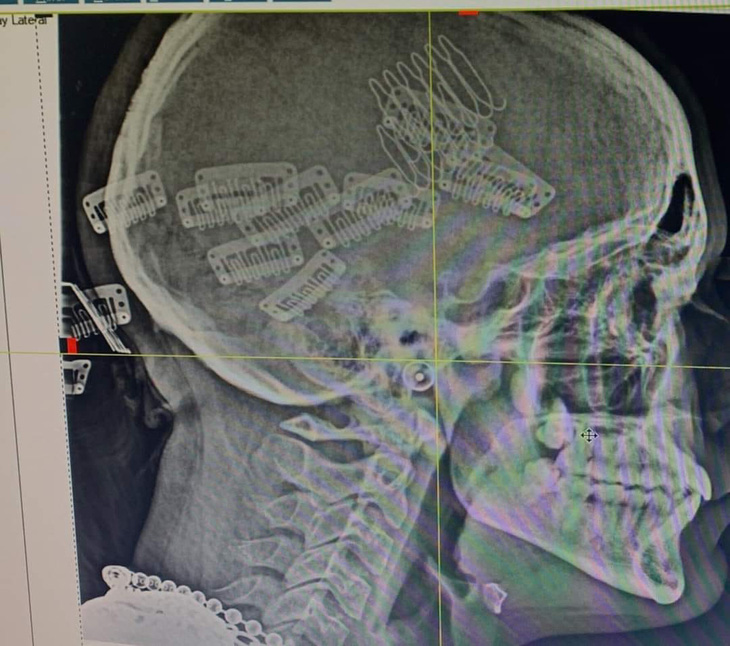 Chụp X-quang nhưng quên gỡ cài tóc.