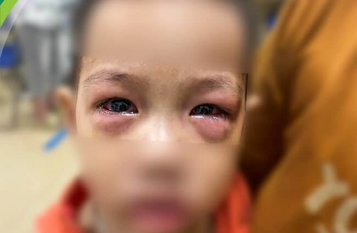 Trẻ bị đau mắt đỏ thăm khám tại Bệnh viện Nhi trung ương - Ảnh: BVCC