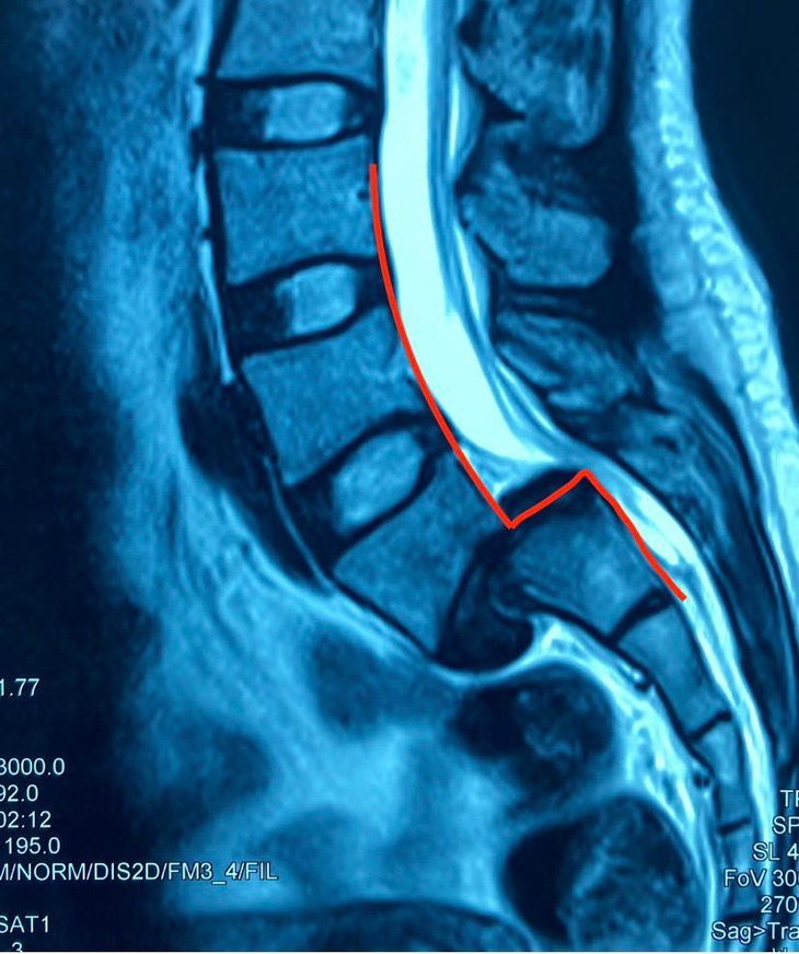 Phẫu thuật thành công xuất sắc cho những người căn bệnh trượt thân ái sinh sống phỏng IV - Hình ảnh 1.