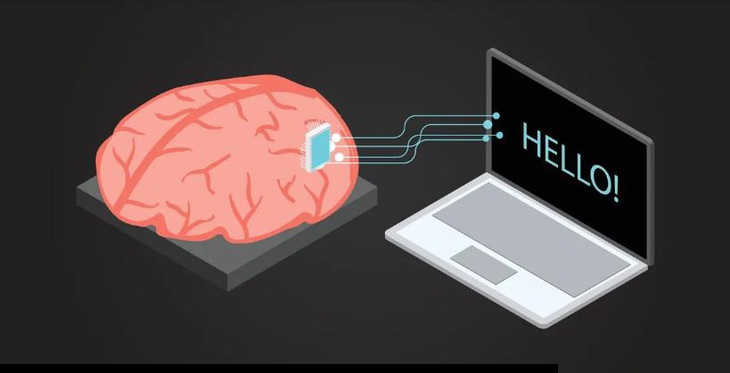 Giao diện não - máy tính giúp người liệt nói chuyện đạt tốc độ kỷ lục