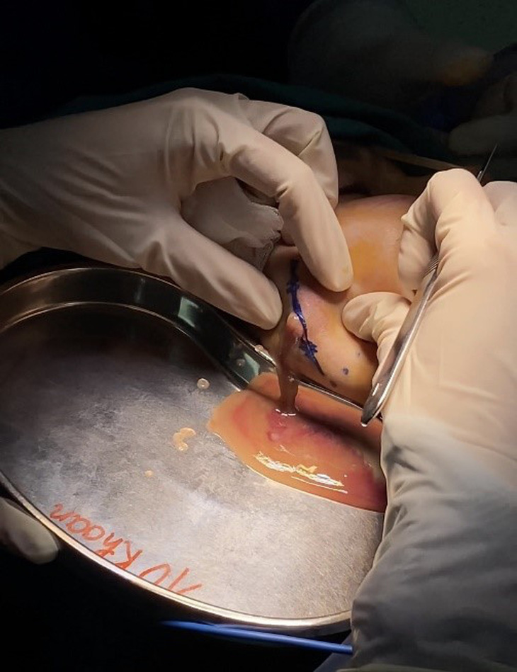 Hình ảnh dịch mủ chứa chất làm đầy từ sau tiêm filler má - Ảnh: Bệnh viện cung cấp