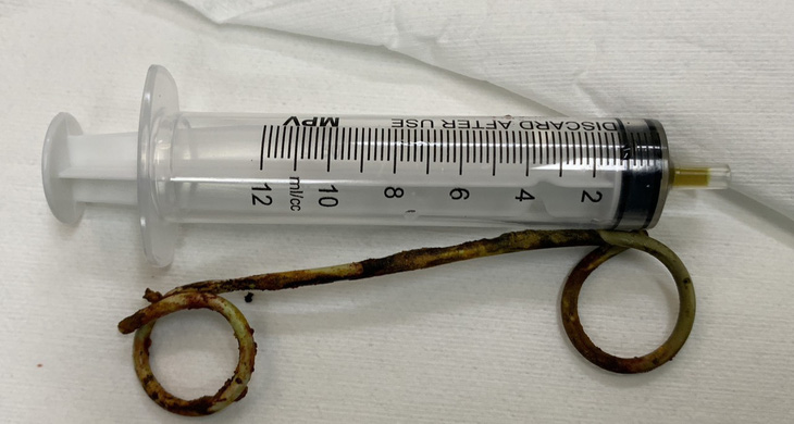 Thiết bị stent được lấy ra từ ống mật của cụ T. sau 6 năm bị bỏ quên - Ảnh: BỆNH VIỆN CUNG CẤP