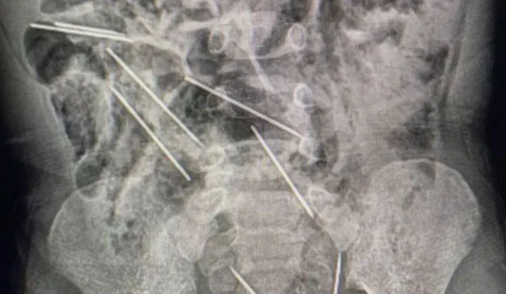 Hình chụp X-quang cho thấy có kim trong vùng bụng của cậu bé - Ảnh: Chính quyền khu vực San Martin