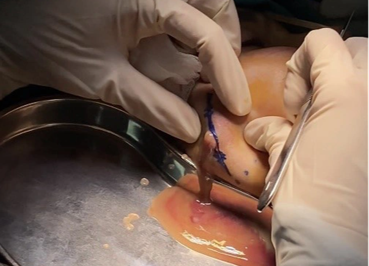 Hình ảnh dịch mủ chứa chất làm đầy từ sau tiêm filler má - Ảnh: Bệnh viện cung cấp