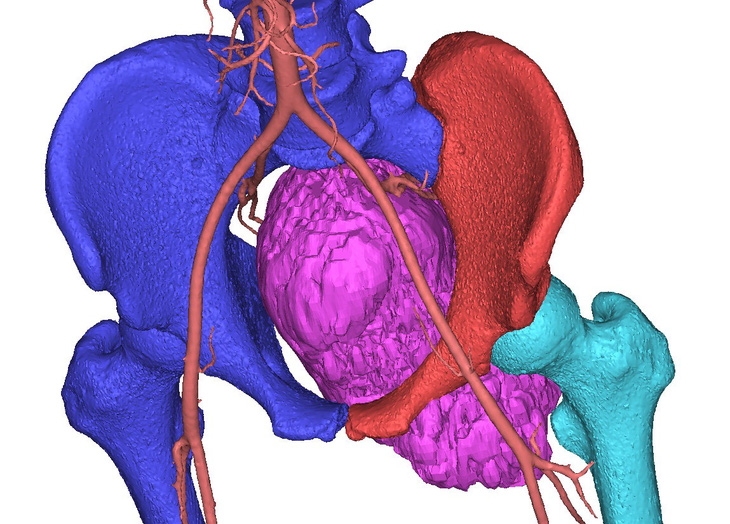 Một khối ung thư sụn (phần màu tím) trên hình ảnh 3D - Ảnh: BVCC