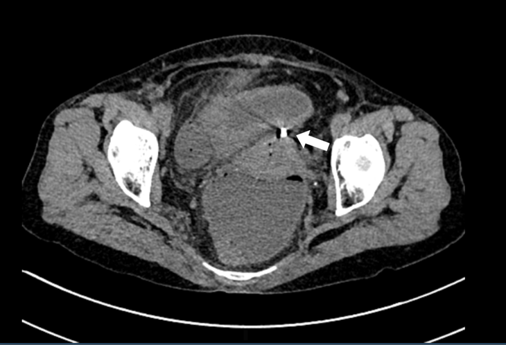 Hình ảnh chụp cắt lớp vi tính dụng cụ tử cung xuyên qua thành tử cung vào ruột - Ảnh: BVCC