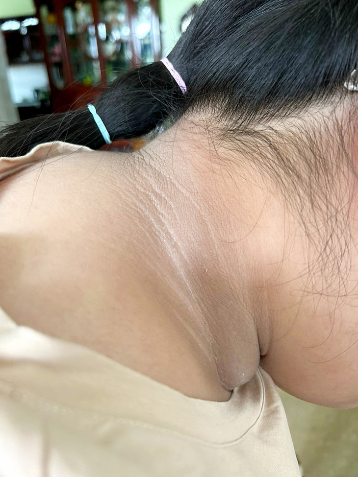 Da cổ bé bị nâu đen, sần sùi - Ảnh: Bác sĩ Úc cung cấp