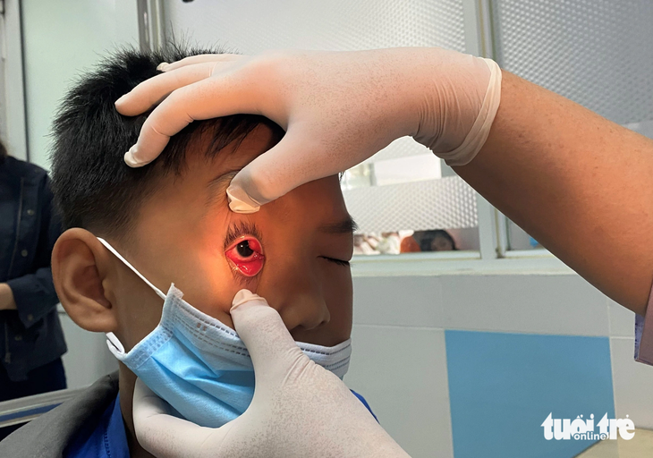 Bác sĩ kiểm tra bệnh nhi mắc bệnh đau mắt đỏ khá nặng tại Bệnh viện Nhi đồng 2 (TP.HCM) - Ảnh: XUÂN MAI