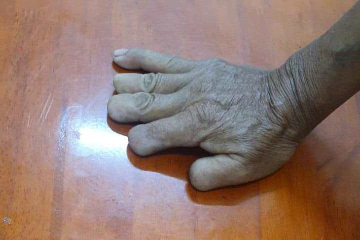 Bàn tay phải cụt bón ngón là đặc điểm nhận dạng dễ nhận biết nhất của bị can Phan Thanh Việt - Ảnh: Công an Quảng Ngãi