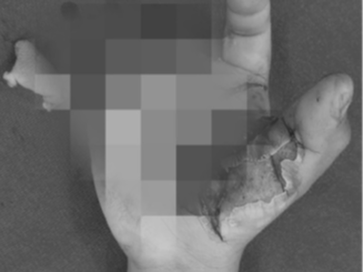 Bàn tay một học sinh bị tổn thương nặng nề sau tai nạn do sử dụng pháo nổ tự chế - Ảnh: BVCC