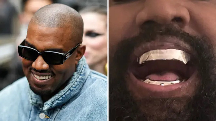 Kanye West với nửa hàm dưới đính kim cương (trái) và bộ hàm bằng titan mới - Ảnh: LBC