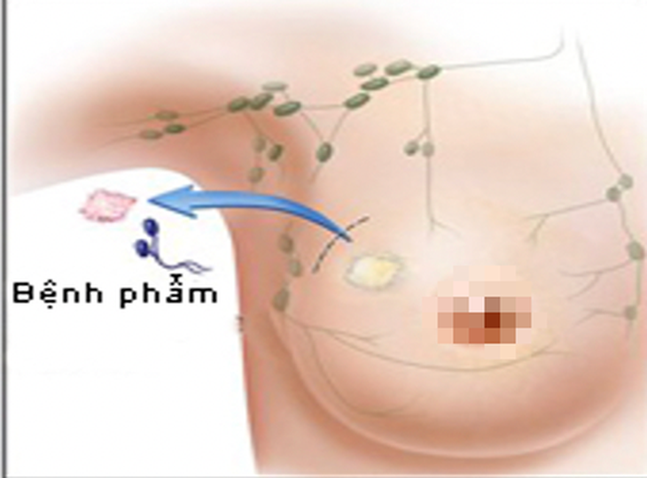 Hình ảnh mô phỏng bệnh nhân ung thư vú 