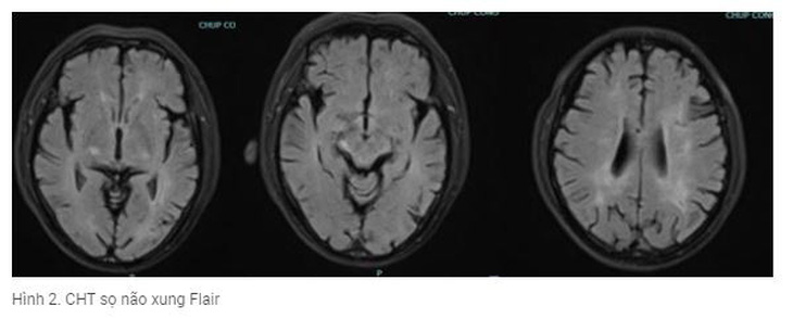 Hình ảnh chụp cộng hưởng từ não của bệnh nhân - Ảnh: BVCC