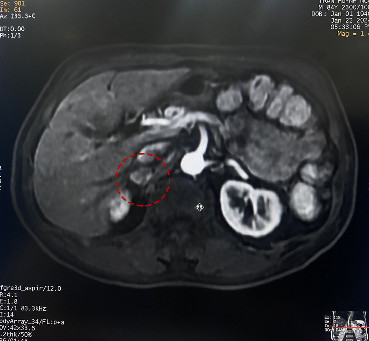 Phát hiện khối u tuyến thượng thận nhờ chụp cộng hưởng từ MRI- Ảnh 1.