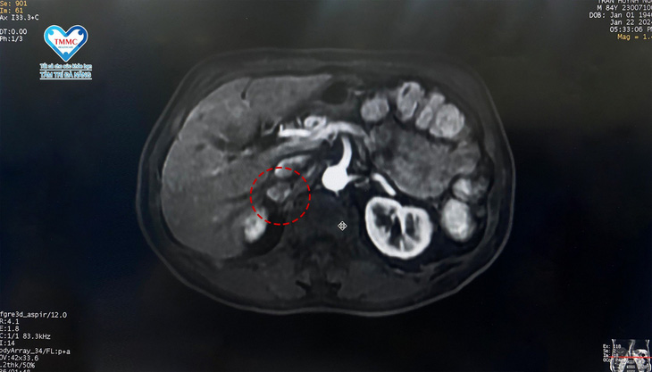 Khối u được chụp bằng cộng hưởng từ MRI tại BV Tâm Trí Đà Nẵng