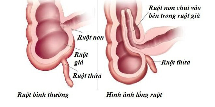 Lồng ruột là một tình trạng cấp cứu ngoại khoa thường gặp ở trẻ em