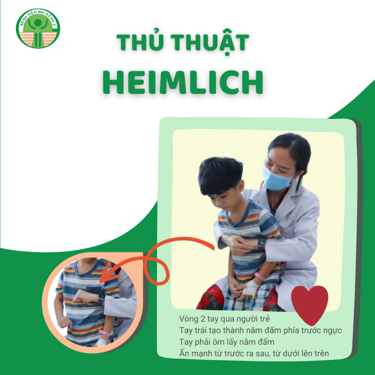 Thủ thuật Heimlich phụ huynh có thể áp dụng với trẻ trên 3 tuổi khi mắc dị vật đường thở - Ảnh: Bệnh viện cung cấp