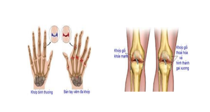 Bấm huyệt ở tay phòng trị được viêm khớp dạng thấp - Ảnh 1.