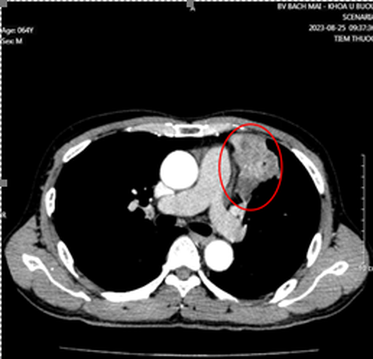 Hình ảnh khối u trên phổi trái của bệnh nhân phát hiện 2 loại ung thư cùng lúc - Ảnh: Bệnh viện cung cấp