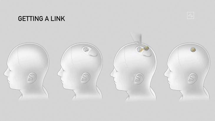Hình minh họa quy trình cấy ghép chip vào não người của Neuralink - Ảnh: AFP