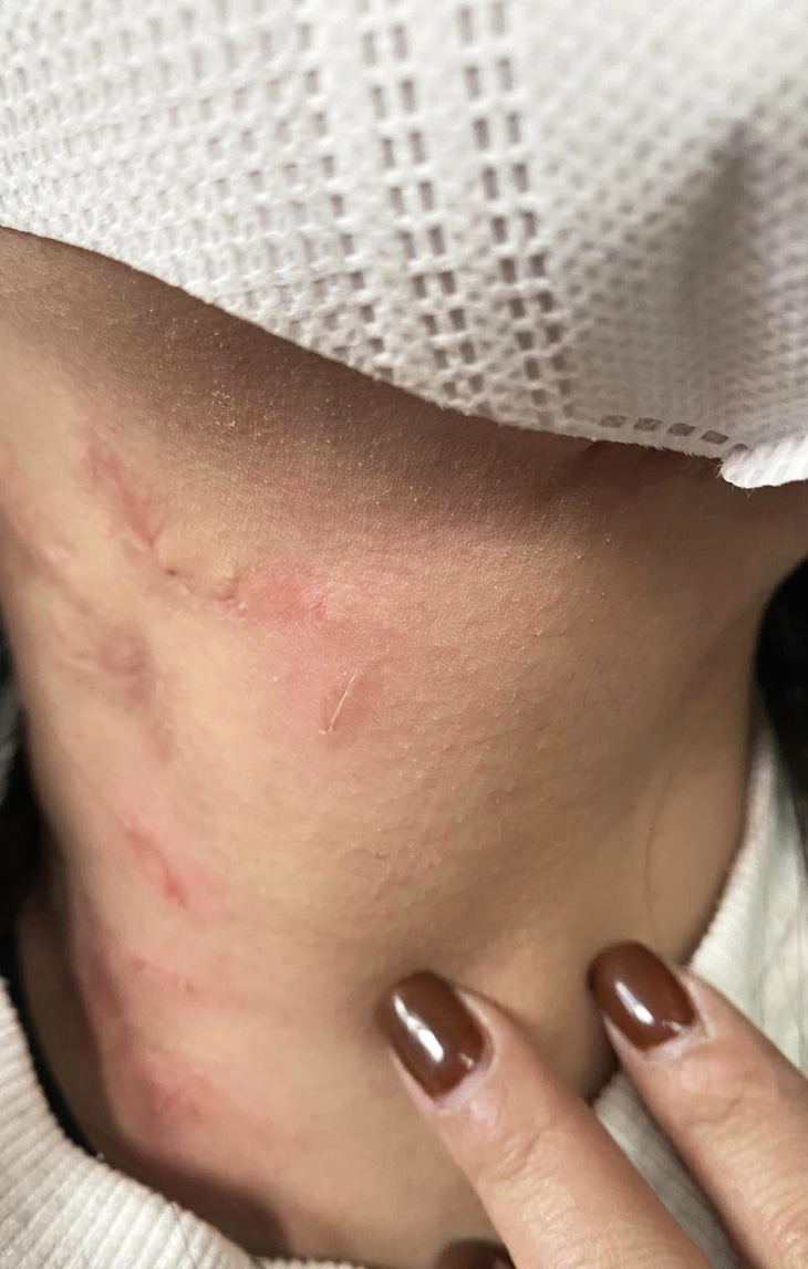 Hình ảnh vết thương tại vùng cổ của người phụ nữ trong bài phản ánh - Ảnh: Facebook Bạch Thị D.