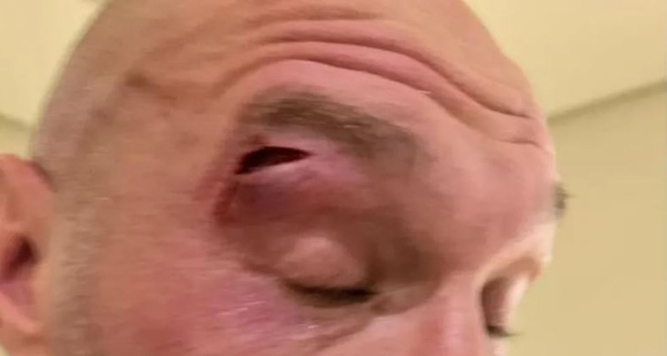 Tyson Fury bị vết cắt khá kinh dị ở phía trên mắt phải, khiến trận đấu thống nhất các đai hạng nặng phải hoãn lại - Ảnh: Getty