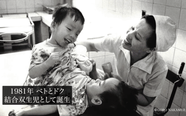 Nhật sắp chiếu phim về người em trong ca mổ tách cặp song sinh Việt, Đức 35 năm trước