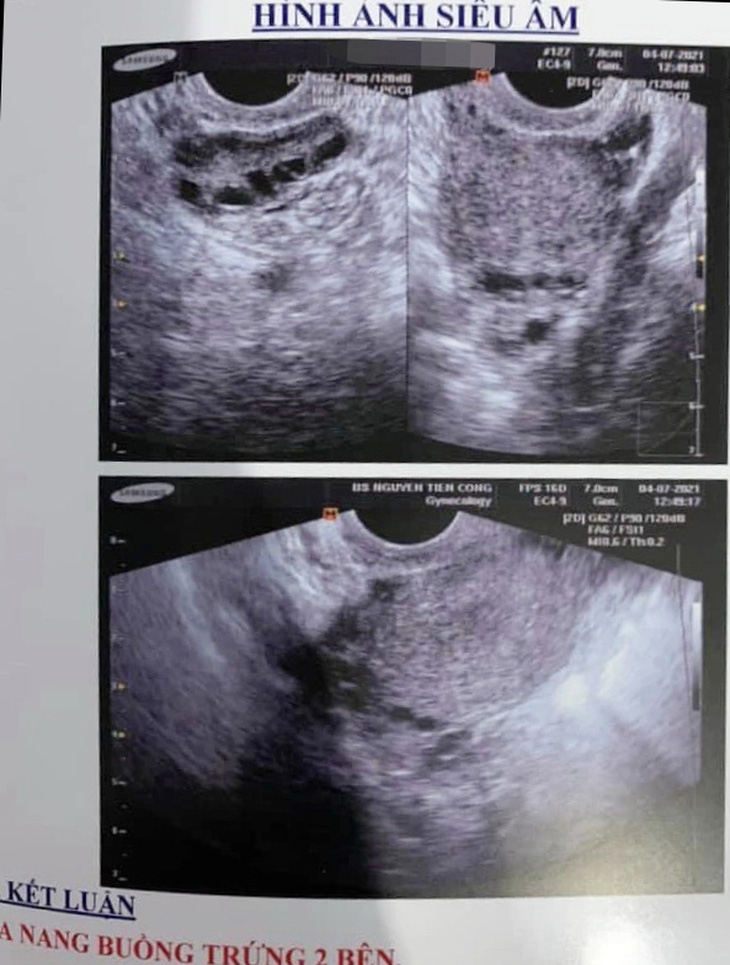 Hình ảnh siêu âm cho thấy buồng trứng có rất nhiều nang nhỏ - một trong những dấu hiệu chẩn đoán mắc hội chứng buồng trứng đa nang - Ảnh: BNCC