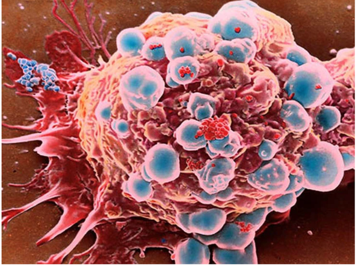 Tế bào ung thư - Ảnh minh họa