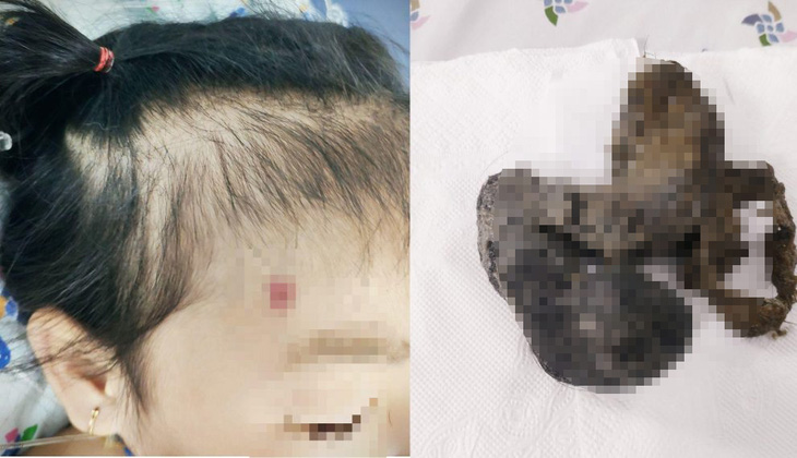 Một trường hợp trẻ tự nhổ tóc của mình và ăn chúng do mắc hội chứng pica - Ảnh: Bệnh viện cung cấp