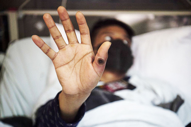 Một bệnh nhân đậu mùa khỉ được điều trị tại bệnh viện ở Lima, Peru - Ảnh minh họa: AFP