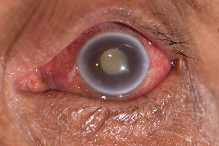 Bệnh glôcôm là nguyên nhân hàng đầu khiến hàng triệu người trên thế giới có nguy cơ mù lòa vĩnh viễn
