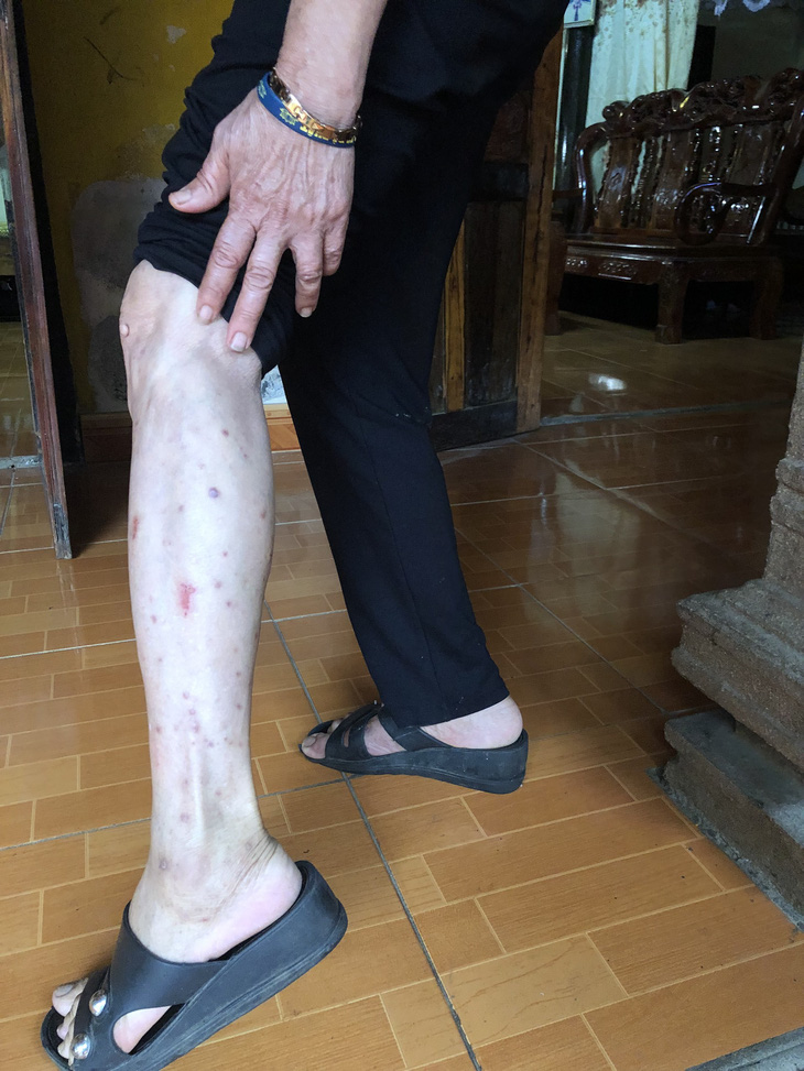 Người dân xã Vĩnh Hòa, huyện Vĩnh Lộc bị nổi mẩn ngứa ngoài da ở bắp chân kéo dài, chưa rõ nguyên nhân - Ảnh: Trung tâm Kiểm soát bệnh tật tỉnh Thanh Hóa cung cấp