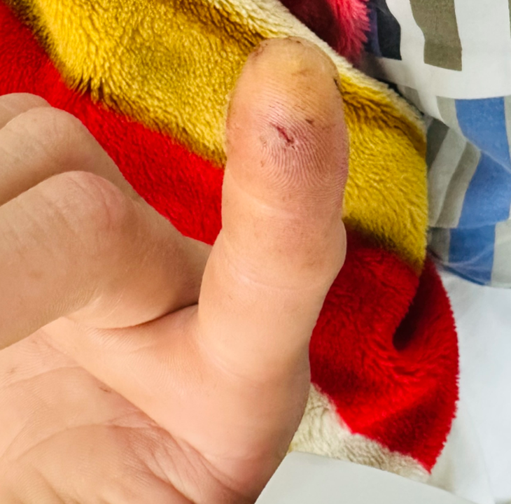 Bệnh nhân bị cu li cắn vào đầu ngón tay - Ảnh bệnh viện cung cấp