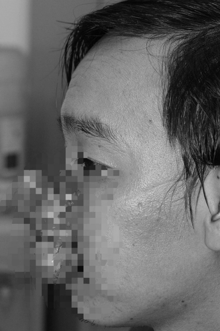 Bệnh nhân có khối u to trên mũi - Ảnh: Bệnh viện cung cấp