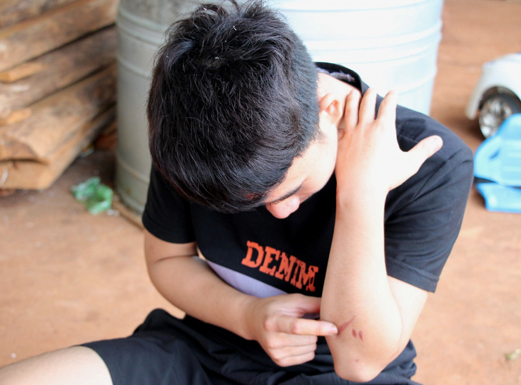 Trong thời gian ở Campuchia, một nạn nhân trú xã Ea Tar (huyện Cư M'gar) bị chích điện, đánh đập, hành hạ và vẫn còn lưu lại dấu vết trên thân thể - Ảnh: N.XUÂN