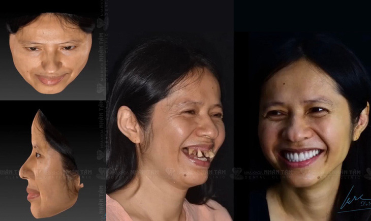 Hình dung cụ thể nụ cười sau điều trị với công nghệ quét mặt 3 chiều