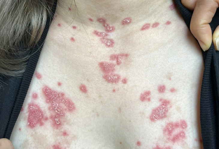Biểu hiện trên da ở bệnh nhân lupus ban đỏ - Ảnh: BSCC