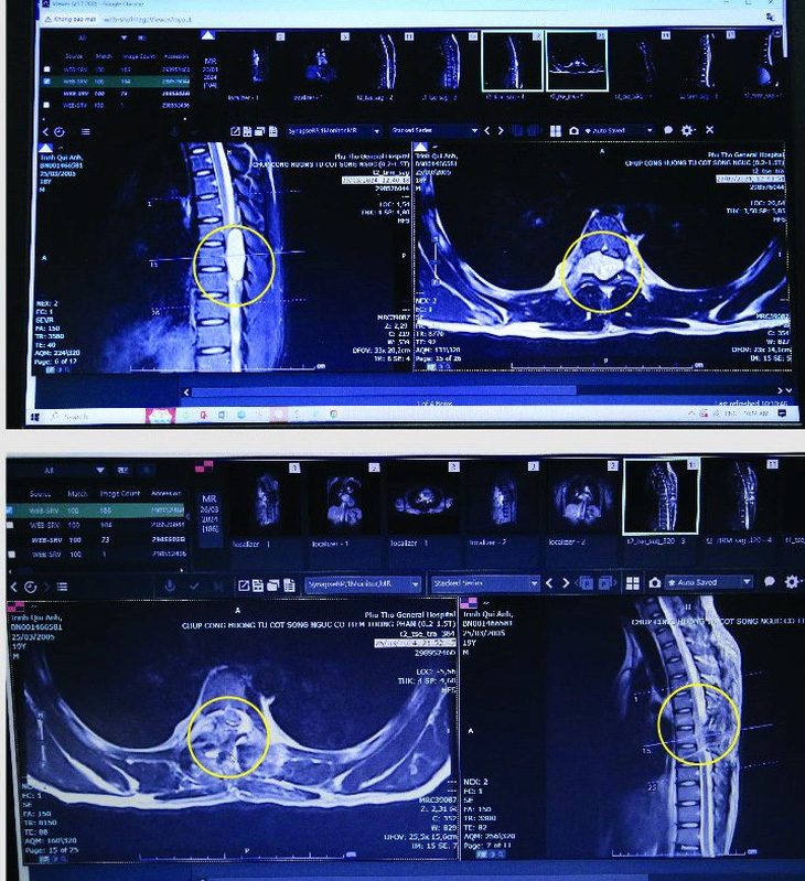 Phim chụp u tủy của bệnh nhân trước và sau phẫu thuật - Ảnh: BVCC