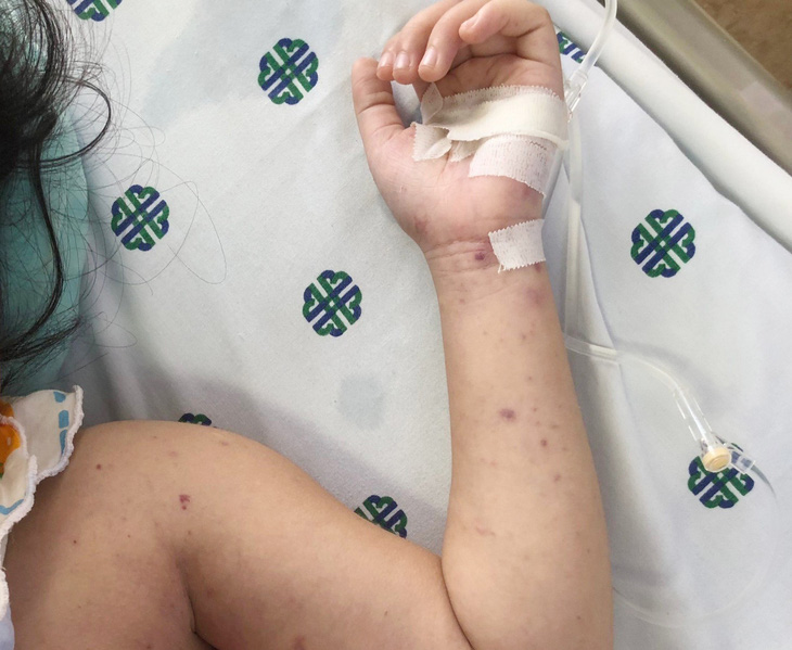 Biểu hiện trên da bé gái 5 tuổi ở Tây Ninh bị nhiễm vi khuẩn não mô cầu - Ảnh: CDC Tây Ninh