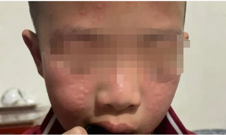 Học sinh Trường tiểu học Hải Bối (Đông Anh, Hà Nội) phát ban sau khi nhà trường phun thuốc diệt muỗi - Ảnh: NVCC