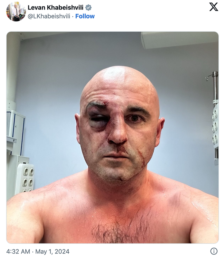 Lãnh đạo đảng đối lập Georgia Levan Khabeishvili đăng hình ảnh bị thương trên mạng xã hội - Ảnh chụp màn hình