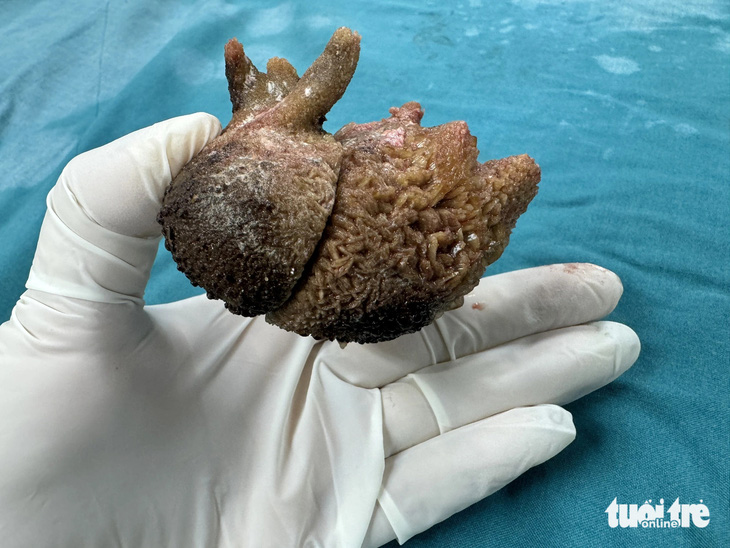 Viên sỏi san hô có kích thước "khủng" được lấy ra từ bệnh nhân T. (61 tuổi, tỉnh Phú Yên) sau ca phẫu thuật - Ảnh: Bệnh viện Đa khoa tỉnh Phú Yên