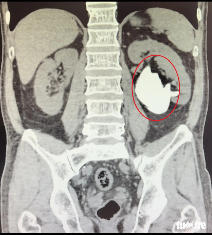 Hình ảnh chụp CT Scan viên sỏi san hô có kích thước "khủng" ở bên trong thận của bệnh nhân T. -  Ảnh: Bệnh viện Đa khoa tỉnh Phú Yên
