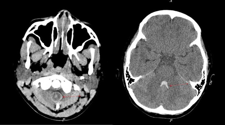 Kết quả CT xuất huyết trong não thất và khoang dịch não tủy ở cột sống cổ của bệnh nhân Đ.N. (10 tuổi) - Ảnh: P.T.