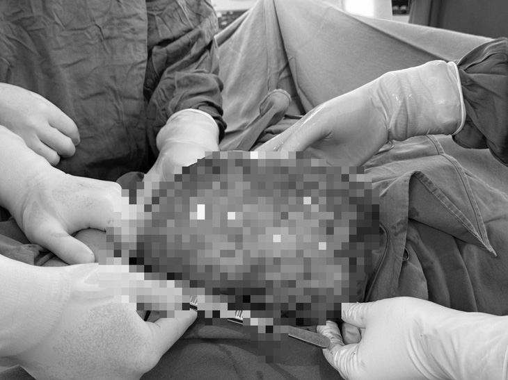 Khối u nặng gần 3kg được các bác sĩ cắt bỏ thành công - Ảnh: Bệnh viện cung cấp